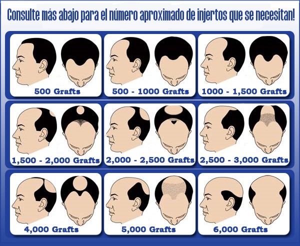 Injerto pelo "Graft"